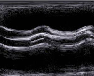 Titelbild KHK, Kardiomyopathien